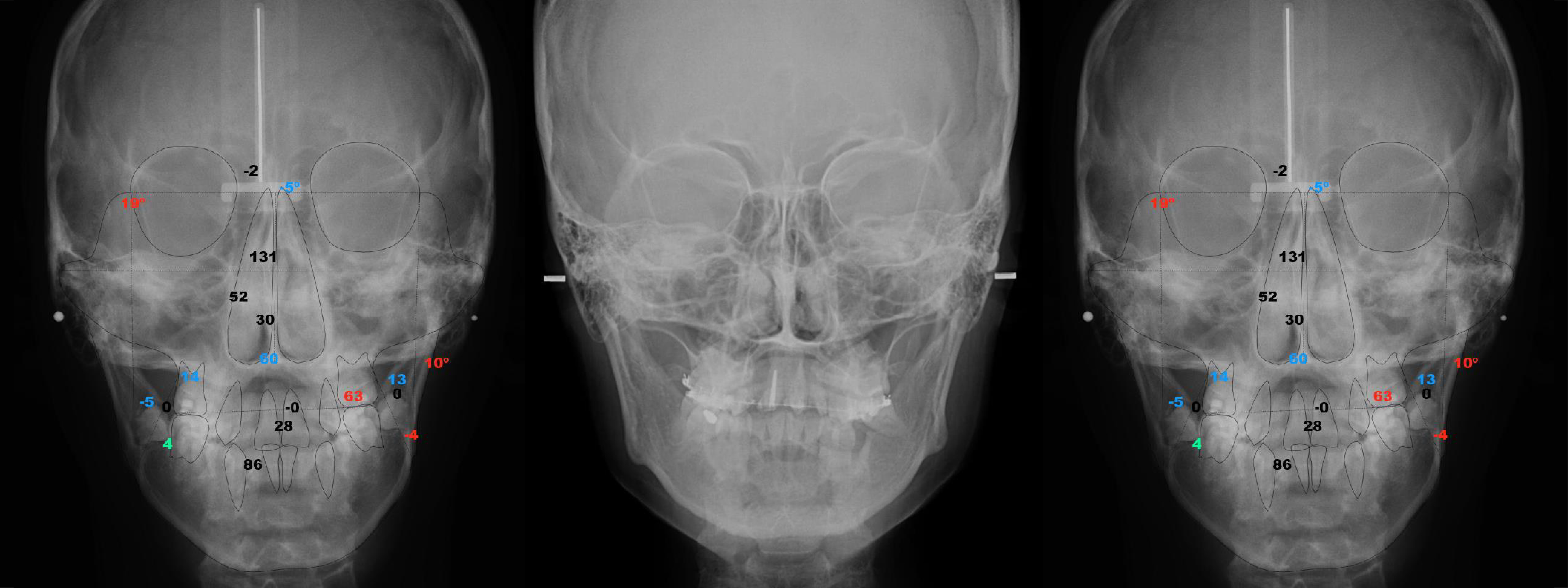 Radiografía Intrabucal